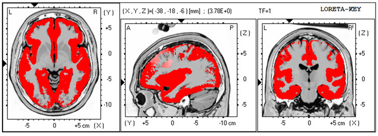 LORETA analysis at 1 Hz showing broadly distributed activity from ECG artifact